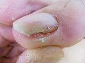 切り過ぎ巻き爪