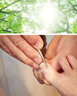 巻き爪矯正イメージ