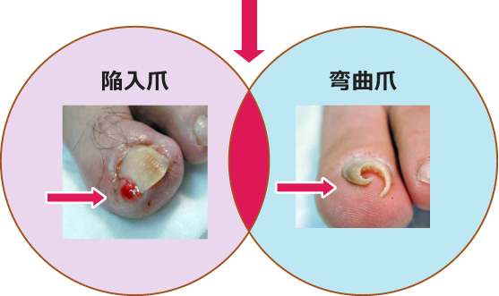 陥入爪と巻き爪（弯曲爪）が合併
