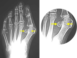 母趾種子骨炎写真1