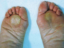 母趾種子骨炎写真2