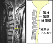 頸椎椎間板ヘルニヤ