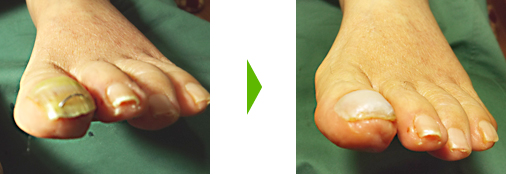 ワイヤーを取り外した巻き爪